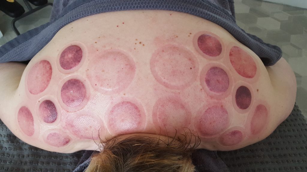 Fire Cupping